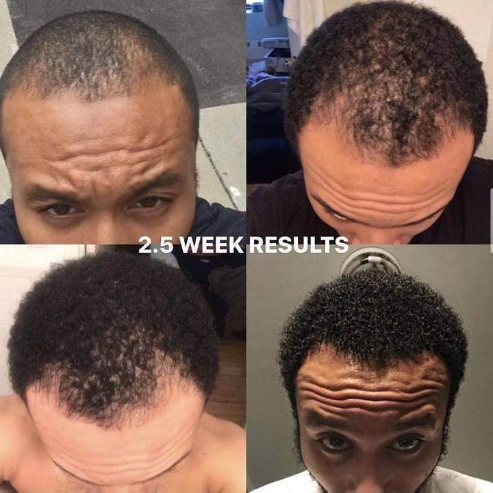 Hairresurrection - Wholesale Hair Oil - Intense Hair Growth Oil5