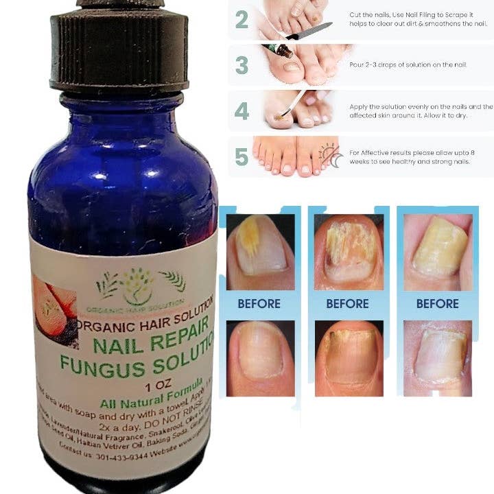 Organic Hair Solution - Wholesale Nagelverzorgingsset - Biologische teennagelschimmelbehandeling Extra Strength - nagelherstel, teennagelverzachter, behandeling van gele teennagels, behandeling van ingegroeide nagel- en voetschimmel, extra stevigheid