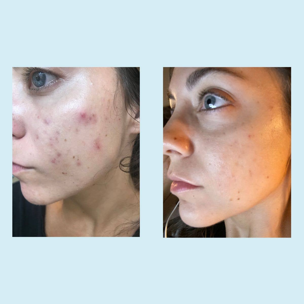 Perfect Image – Engroshandel Ansigtsrens – Salicylsyre dybderensende gel6