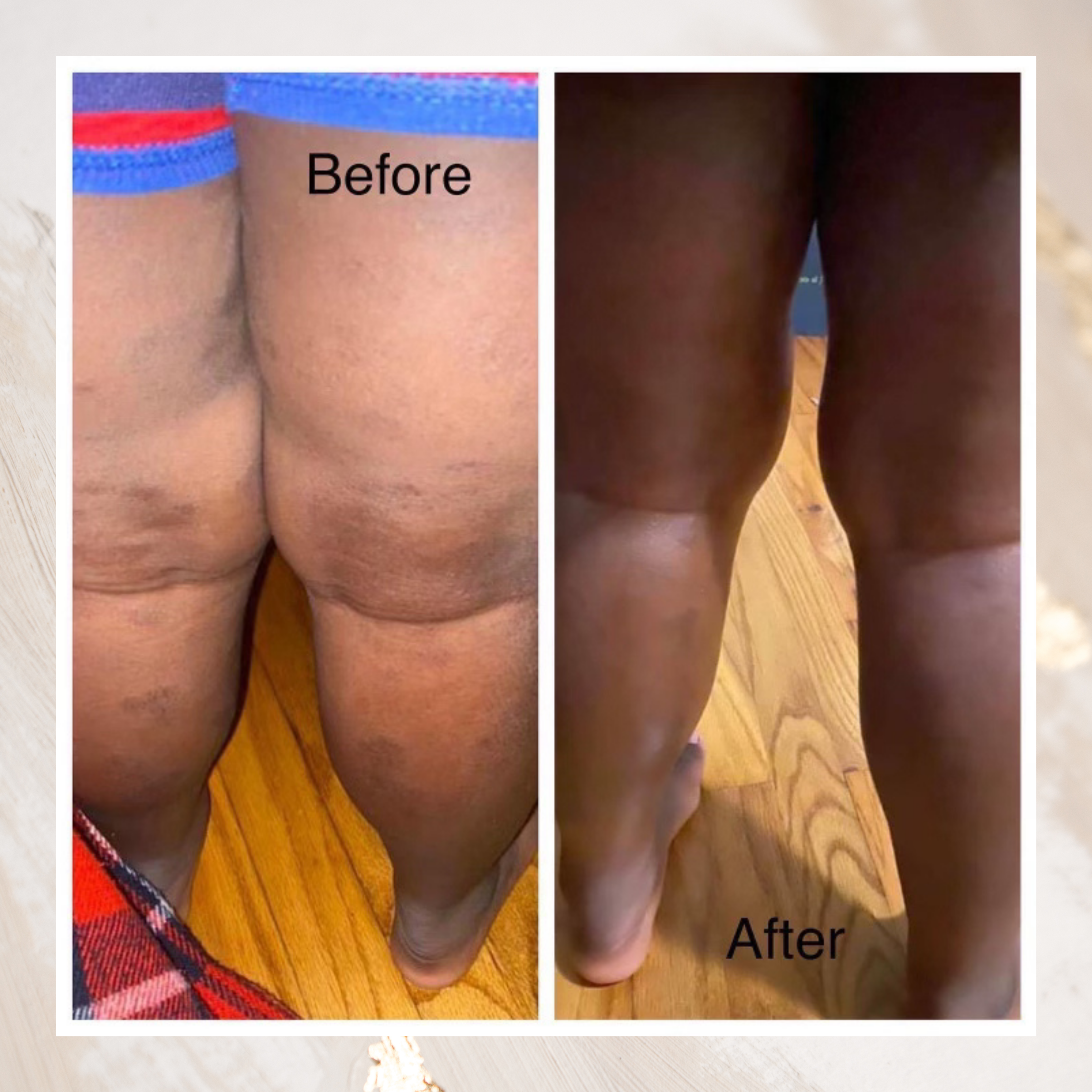 Natural Aesthetics - Wholesale Eczema Treatment - Natural Eczema Bundle2