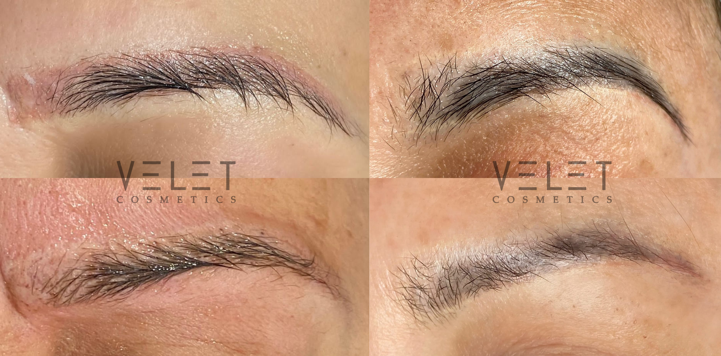 VELET COSMETICS - Wholesale Facial peel - VV Remuver | Pigment and tattoo remover2