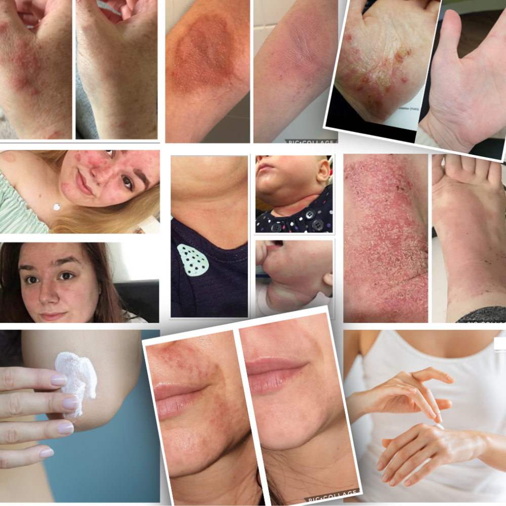 Allay Organics – wholesale Läkande salva/balsam/kräm – Lugn kräm för psoriasis, eksem, dermatit med vitamin D36