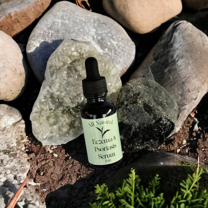 Sérum contre l'eczéma et le psoriasis pour la vente par The Mystic Butterfly Shop