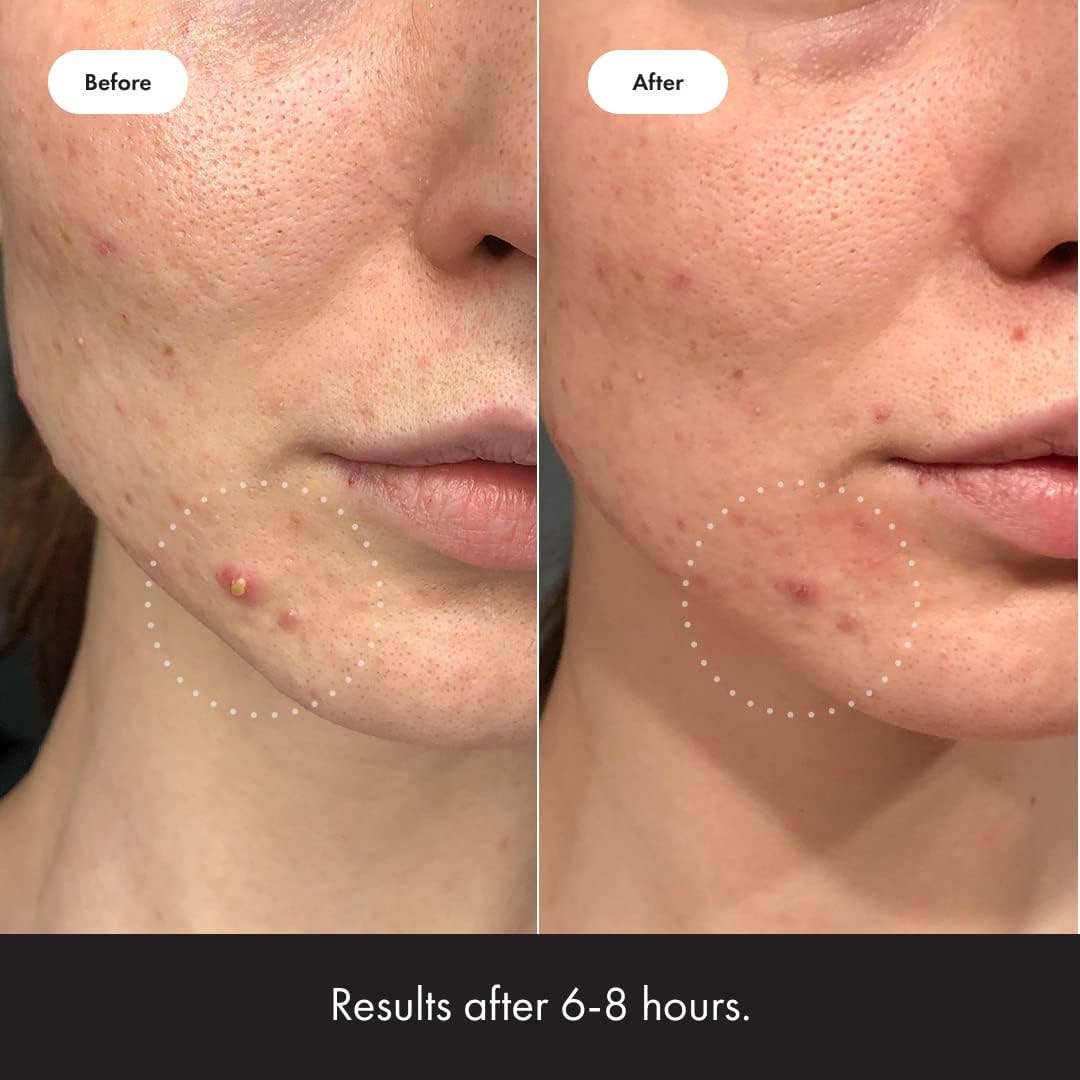 MEHIAZ - Wholesale Acne/Hydrocolloid Patch - Mighty Patch Invisible+ Acne Patches (39 ct)3