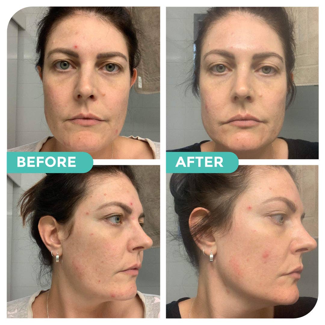 Hemp Co Australia - Wholesale Facial Care Set/Kit - Acne skincare bundle6