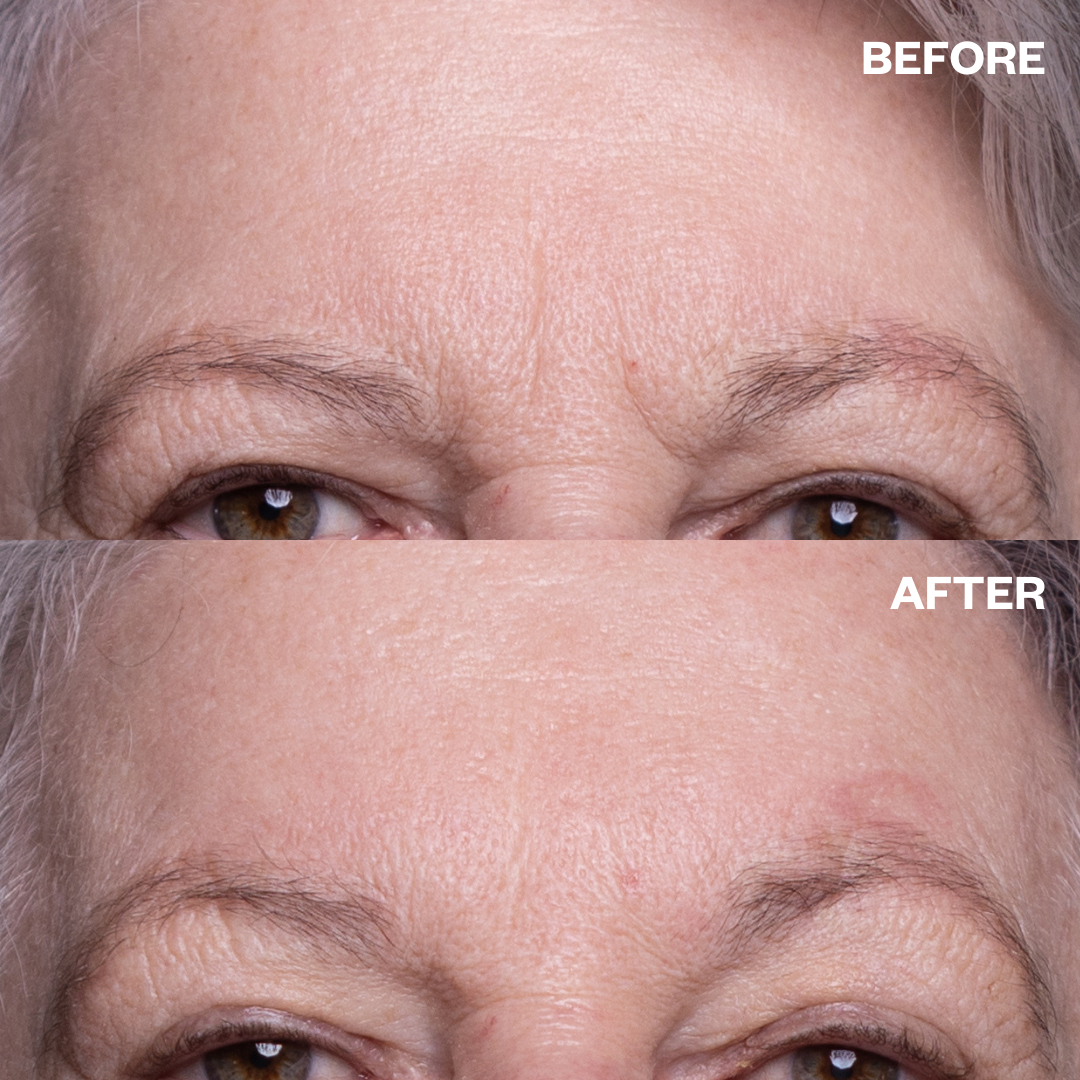 Abundance Naturally Ltd. - Wholesale Acne/Hydrocolloid Patch - Wrinkles Schminkles | Forehead Wrinkle Patch4