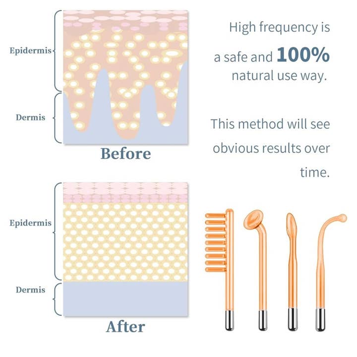 Champione By Mileva – wholesale Electronic skincare device – High Frequency Skin Wand + 3 Skin Masks2