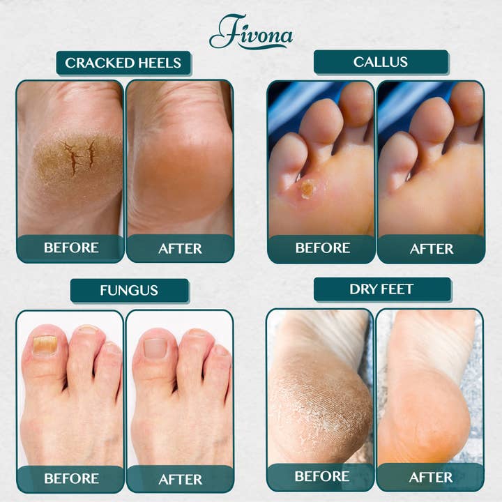 FIVONA - Wholesale Hand/Foot Soak - Tea Tree Foot Soak Epsom Salt with Oils - 2Lb6