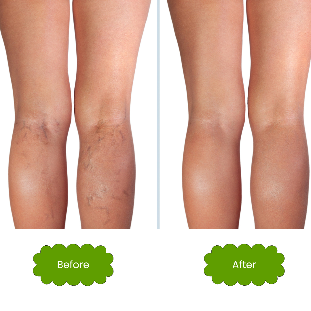 Isabella's Clearly - Wholesale Facial Oil - VEIN, Varicose and Spider Vein Support Oil for Face and Body7