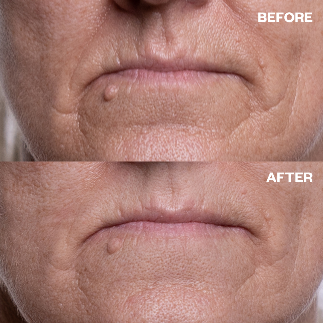 Wrinkles Schminkles - Wholesale Lip Treatment/Mask - Mouth Wrinkle Patches4