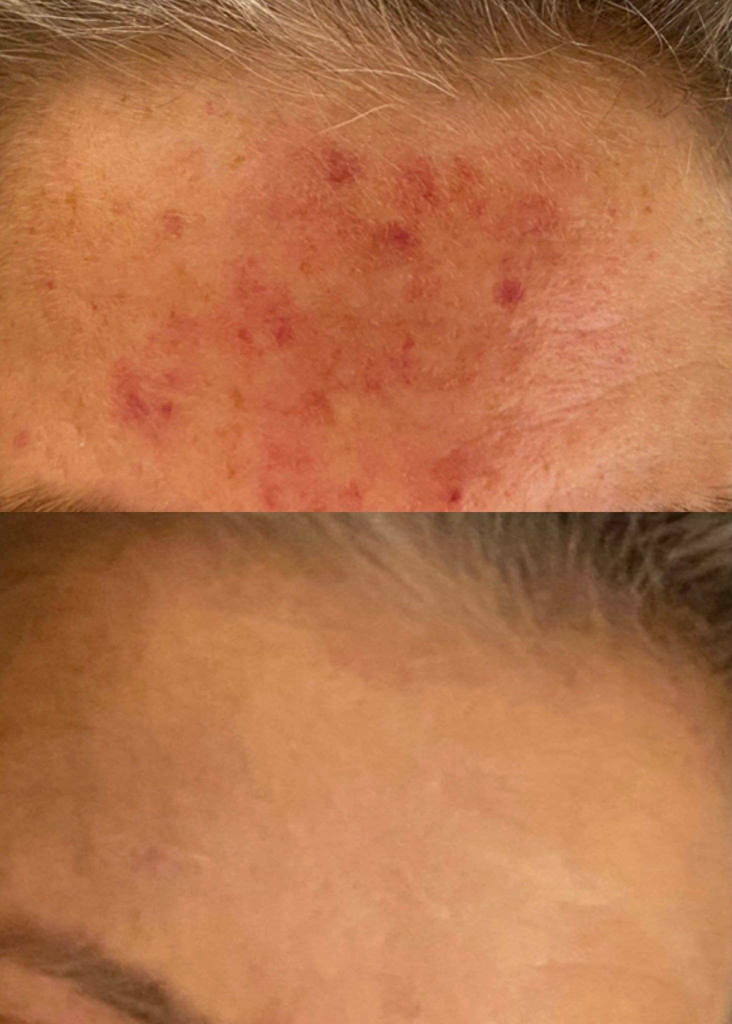 August & Monroe, Inc - Wholesale Acne/Hydrocolloid Patch - 3-IN-1 BLEMISH CAMOUFLAGE6