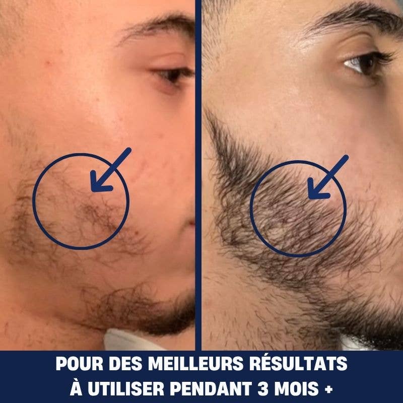 La Douce barbe - Wholesale Electronic Skincare Device - Dermaroller3