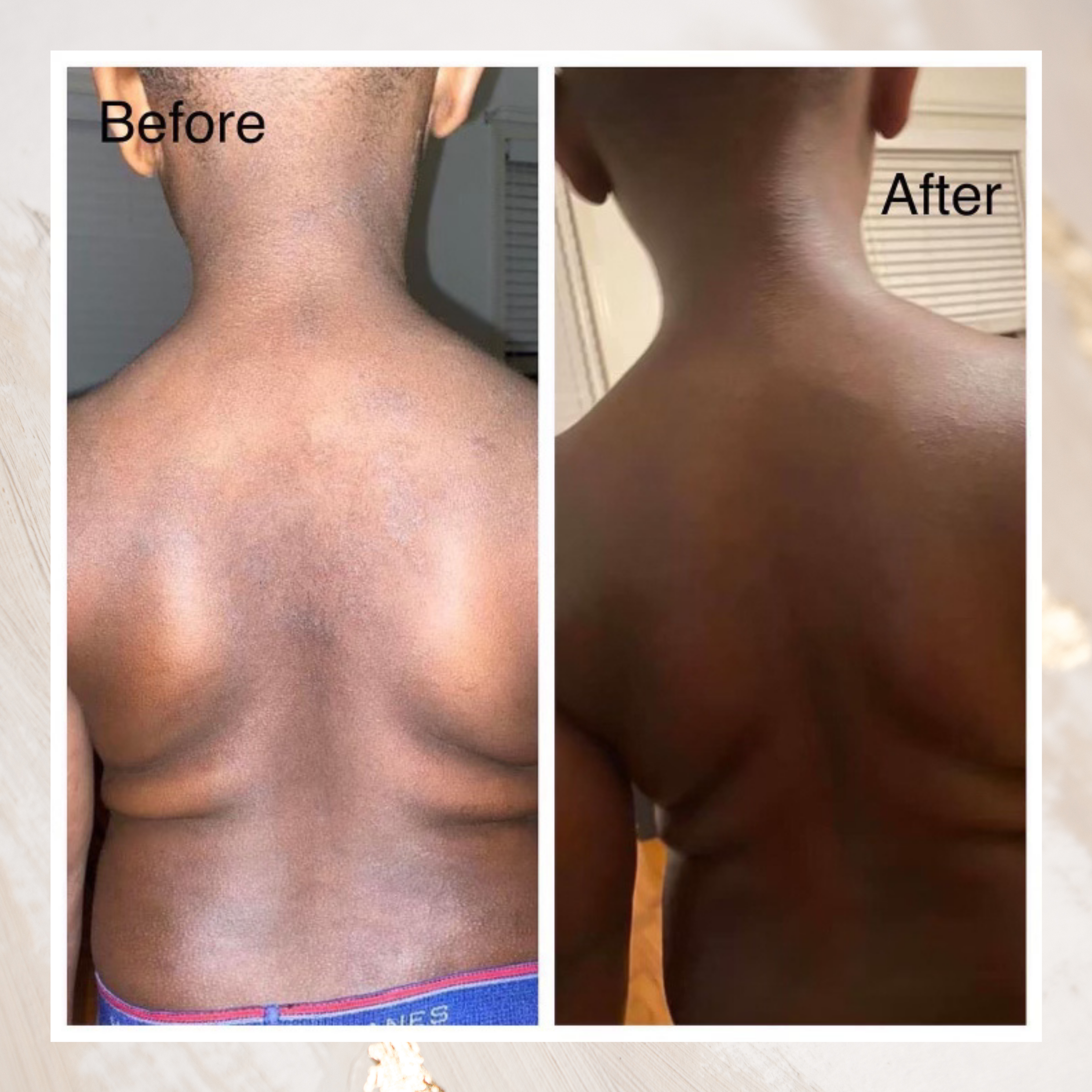 Natural Aesthetics - Wholesale Eczema Treatment - Natural Eczema Bundle1