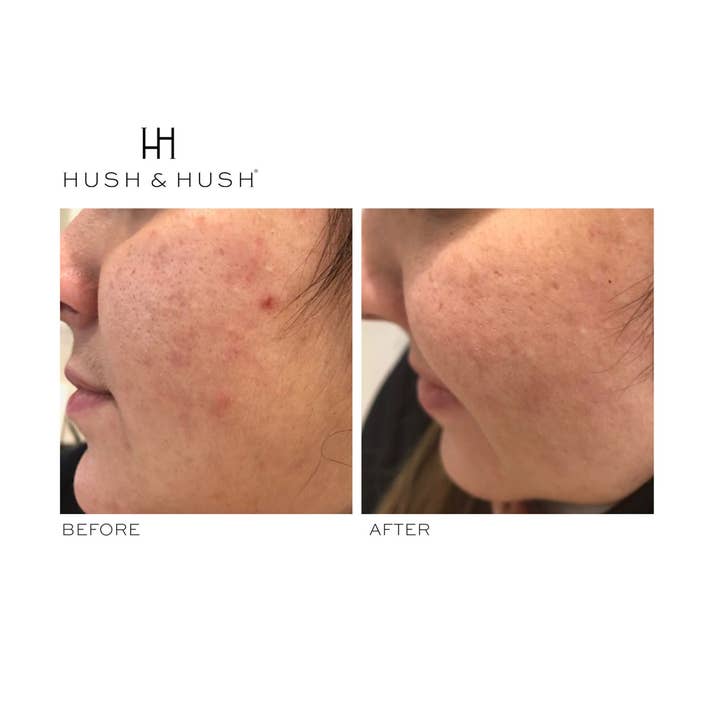 Hush & Hush - Wholesale Oral Supplement/Vitamin - Natural Supplement for Breakouts6