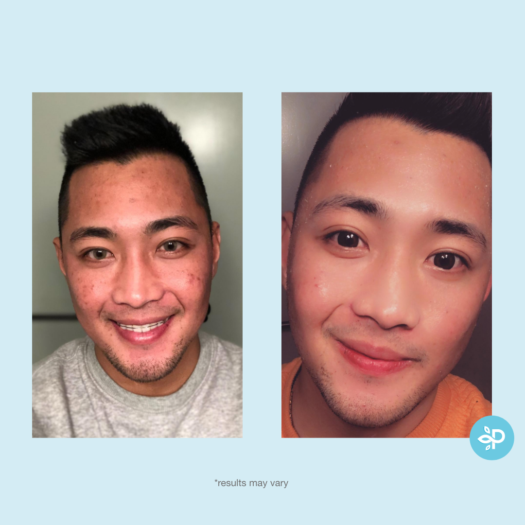 Perfect Image - Wholesale Facial Peel - Revitaboost Peel Pads  - Level 26