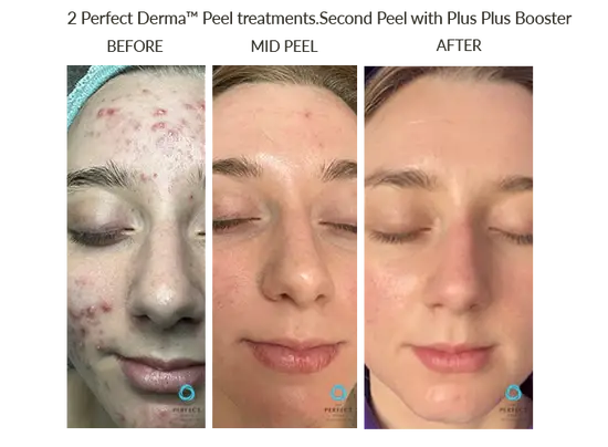 Everybody Has Skin LLC - Wholesale Facial Peel - THE PERFECT ACNE PEEL 4
