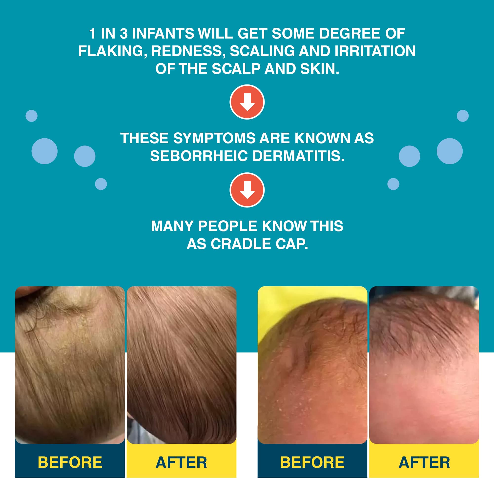 Happy Cappy - Wholesale Baby Bath Set - Kids & Baby - Happy Cappy Cradle Cap Shampoo & Body Wash + Silicone Brush14