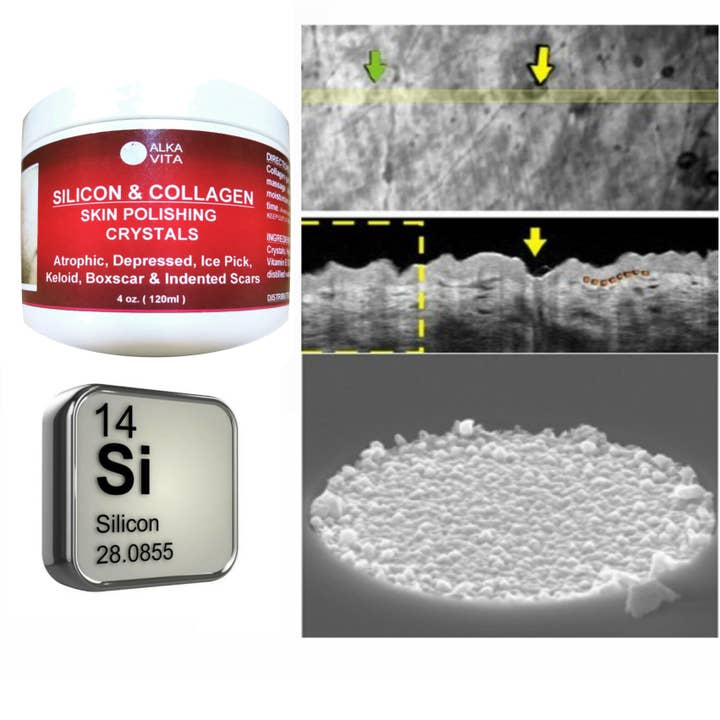 AlkaVita – Großhandel Akne-/Hydrokolloid-Pflaster – Silicon- und Kollagenpoliergel mit Kristallen gegen Aknenarben und Hautunebenheiten4