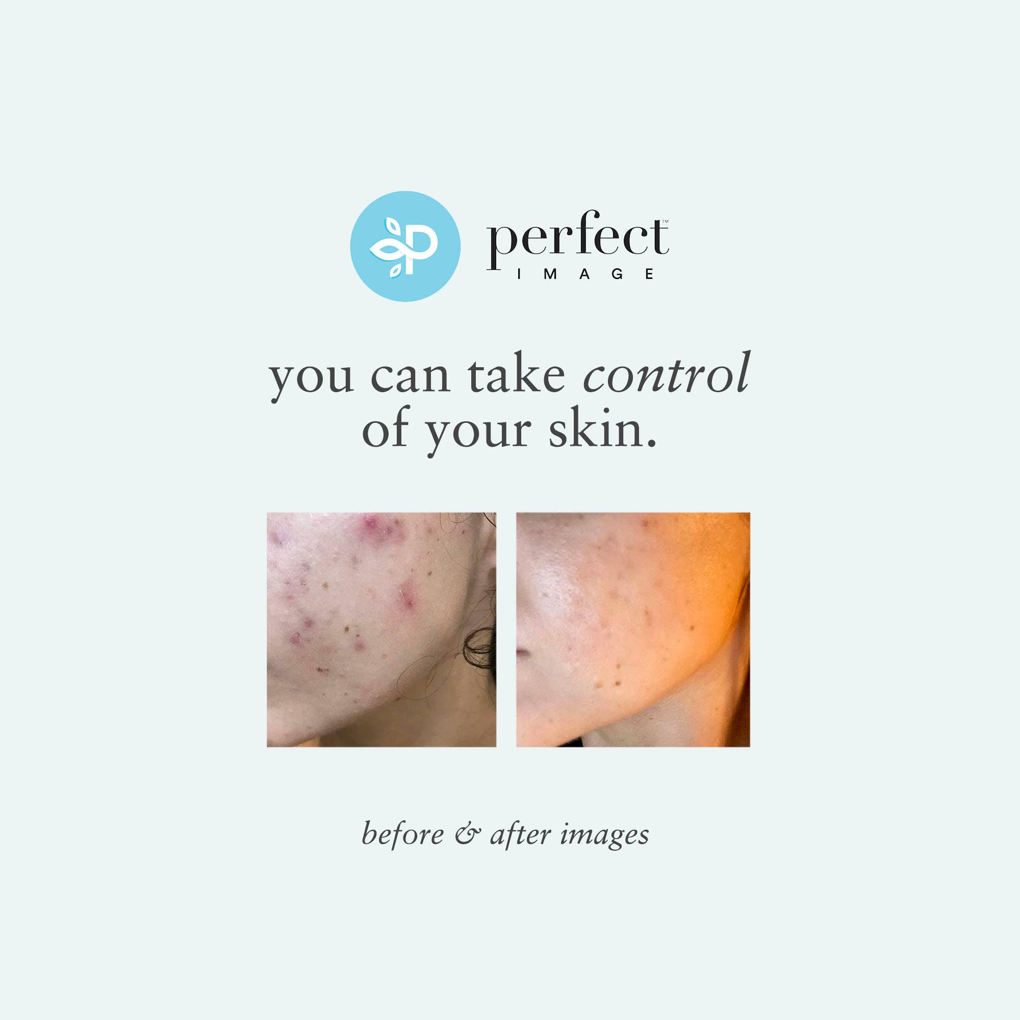 Perfect Image - Vendita all'ingrosso Peeling viso - Tri-Clarity Peel Pads - Livello 16