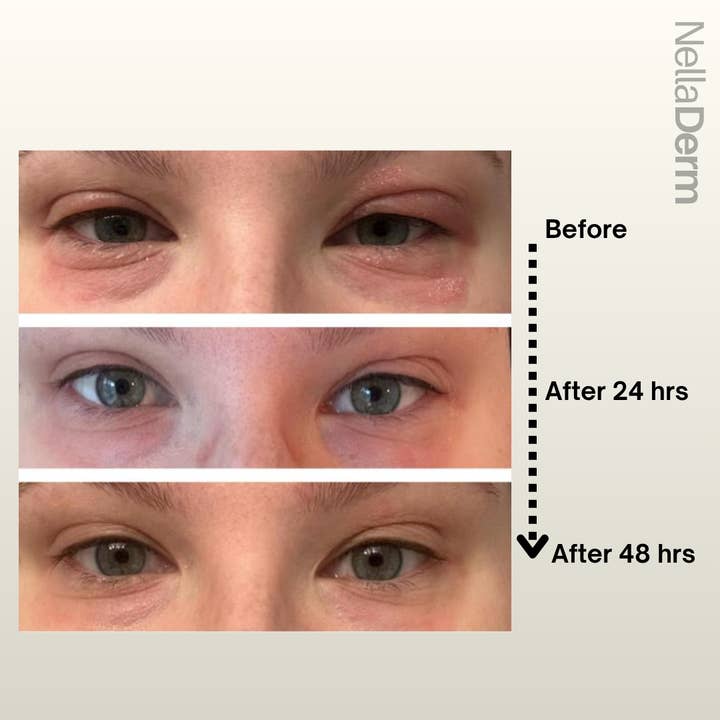 NellaDerm Therapeutics - Wholesale Behandeling van eczeem - NovaNella - Premium Eczeem Balsem (100% Natuurlijk - 30 ml)4