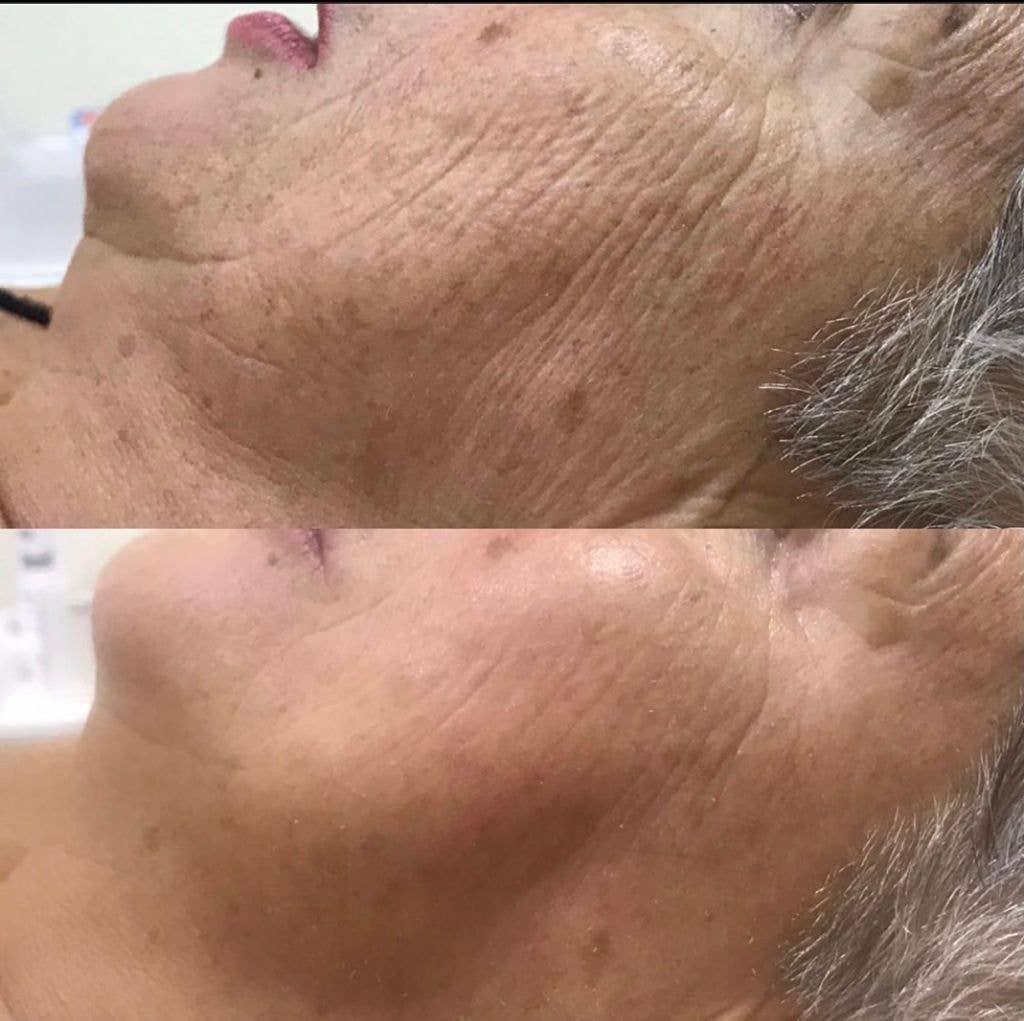 EuDerme – Großhandel Gesichtspflege-Set – Virtuelle Mesotherapie1