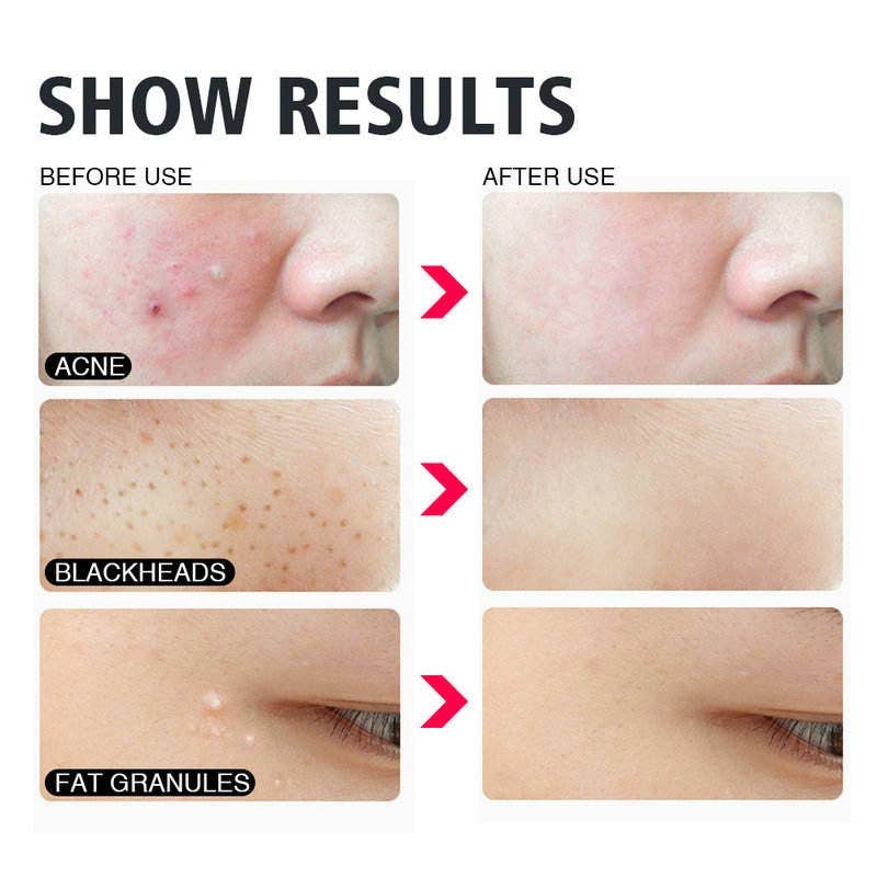 1 Pack (Misture & Match Padrões) Agulhas de remoção de pretos de qualidade Premium 4 pcs Acne para venda a revendedores na Faire14