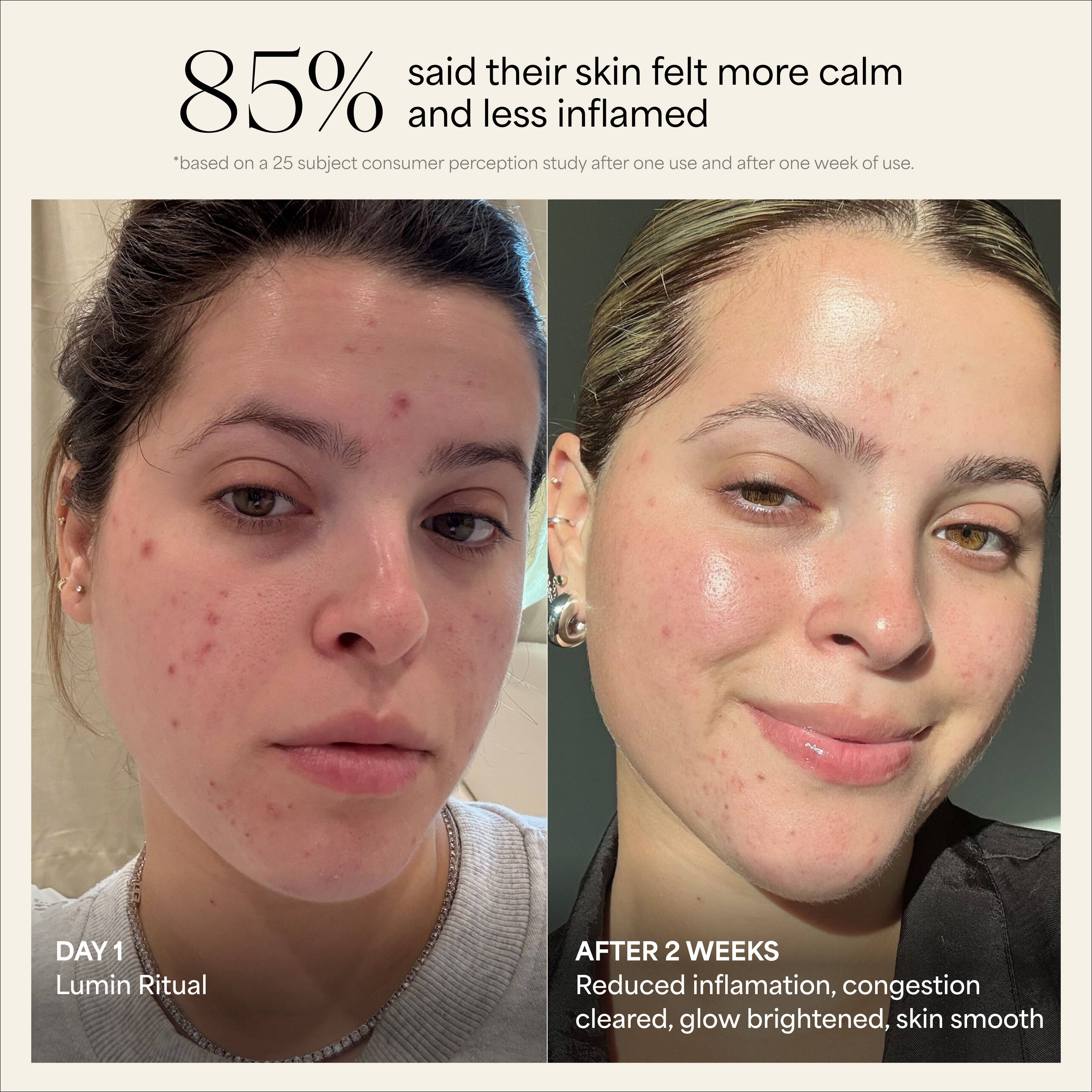 Wildling - Wholesale Body Cupping-set - Lumin cupping set voor gezicht en hals1