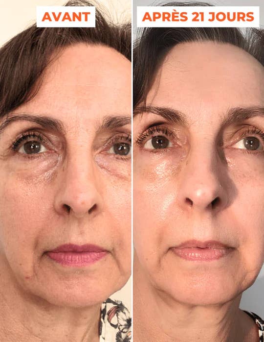 DERMEDEN - Vente Masque exfoliant pour le visage - Peeling avancé en 2 étapes inspiré de techniques dermatologiques3