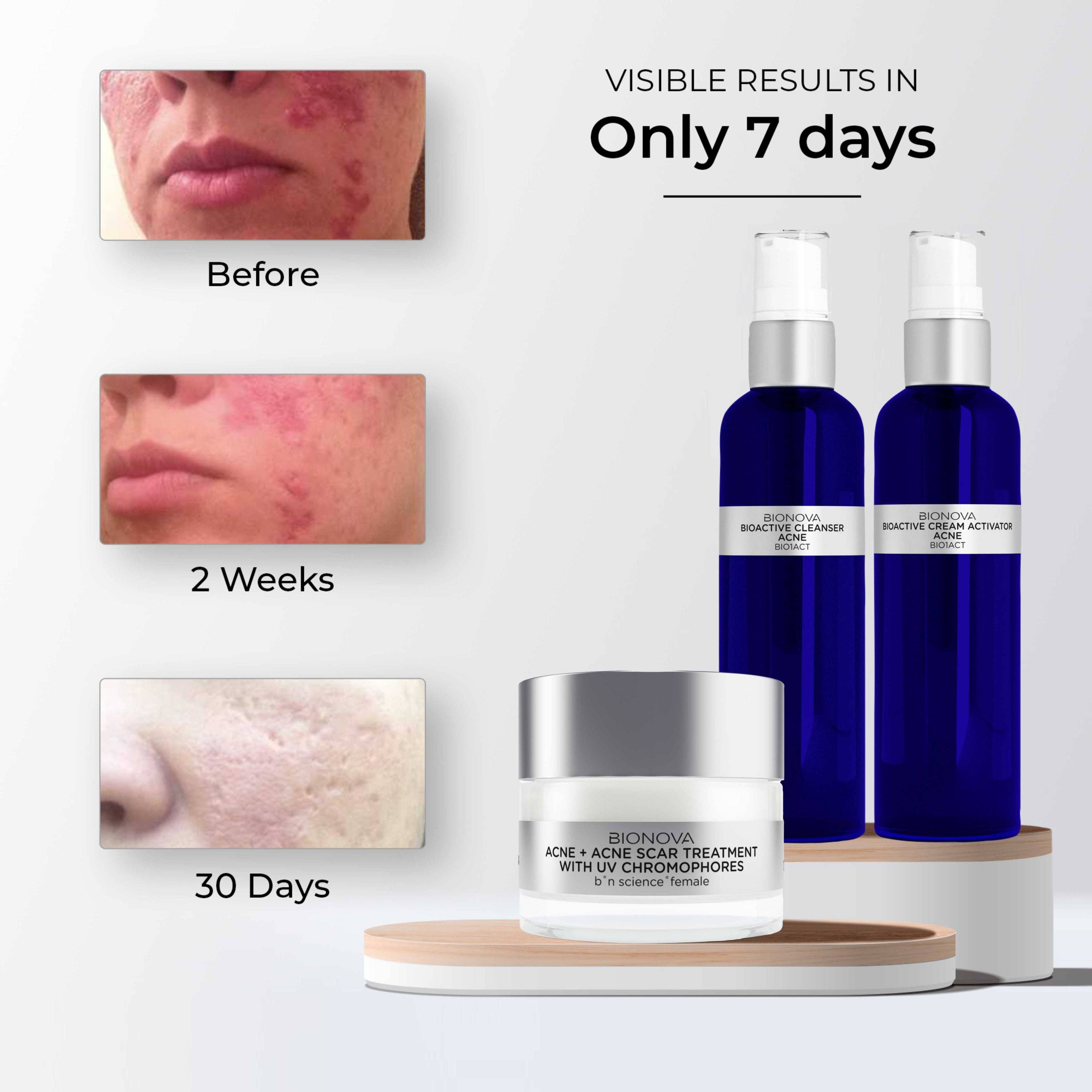 BIONOVA BN Science - Vente Patch contre l'acné/hydrocolloïde - Traitement de l'acné et des cicatrices d'acné avec chromophores UV3