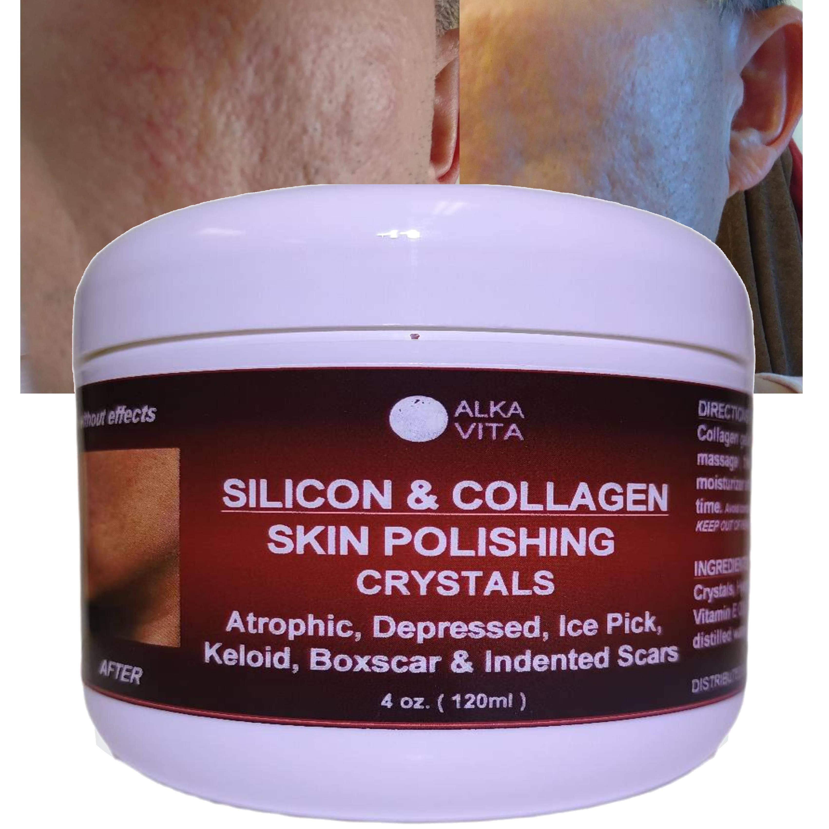 AlkaVita – Großhandel Akne-/Hydrokolloid-Pflaster – Silicon- und Kollagenpoliergel mit Kristallen gegen Aknenarben und Hautunebenheiten1