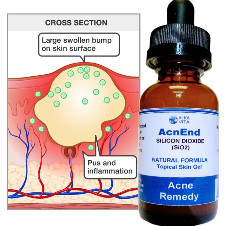 AlkaVita - Wholesale Acne/hydrocolloid patch - Cystic Acne Remedy AcnEnd Gel Silicon Dioxide Fast Results3