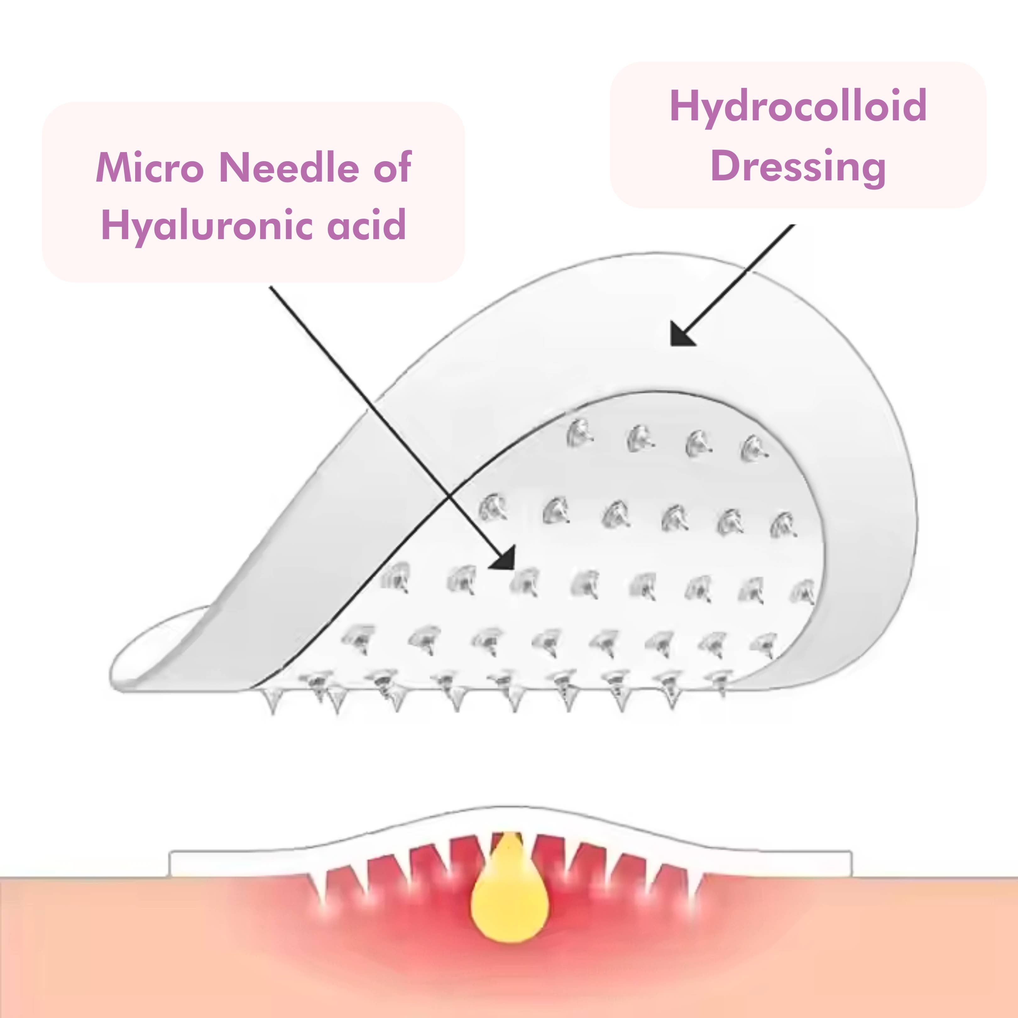 GenovieMD - Wholesale Acne/Hydrocolloid Patch - Microneedle Pimple Patches [9 Pcs] – Fast & Effective Acne3