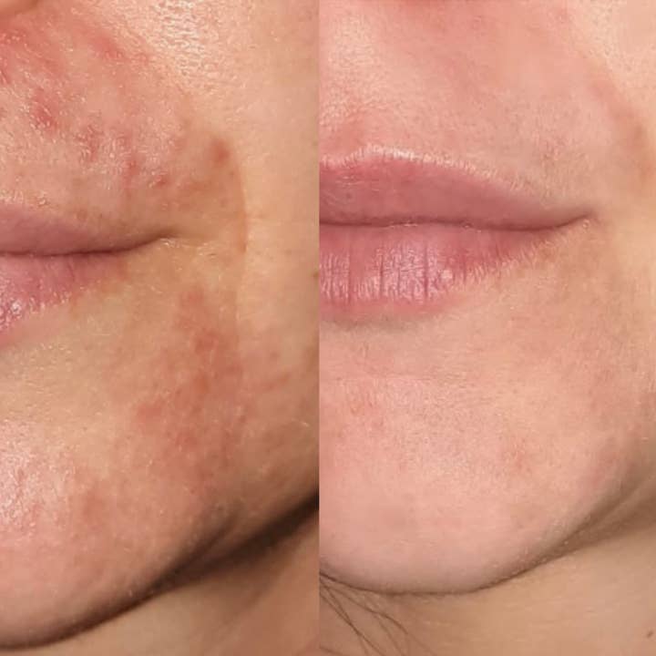 Allay Organics - Vendita all'ingrosso Unguenti/Balsami/Creme curative - Crema calmante per psoriasi, eczema, dermatite con vitamina D3