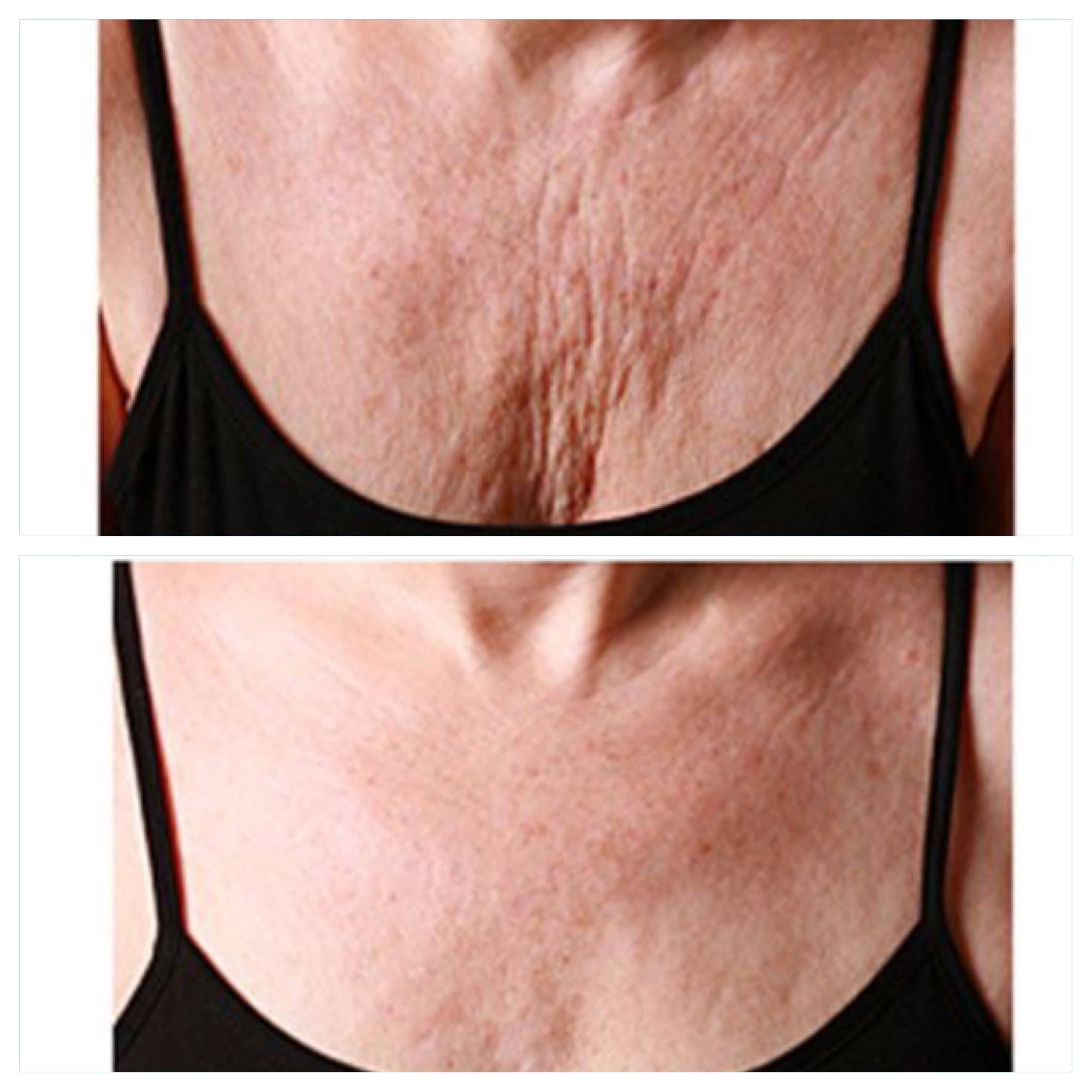 Kami Pure - Anti-Aging Silicone Gel Pads - Wholesale Skincare Face Mask - Wrinkle Recovery Chest Pad – Gift for Mom, Gift for Sister1