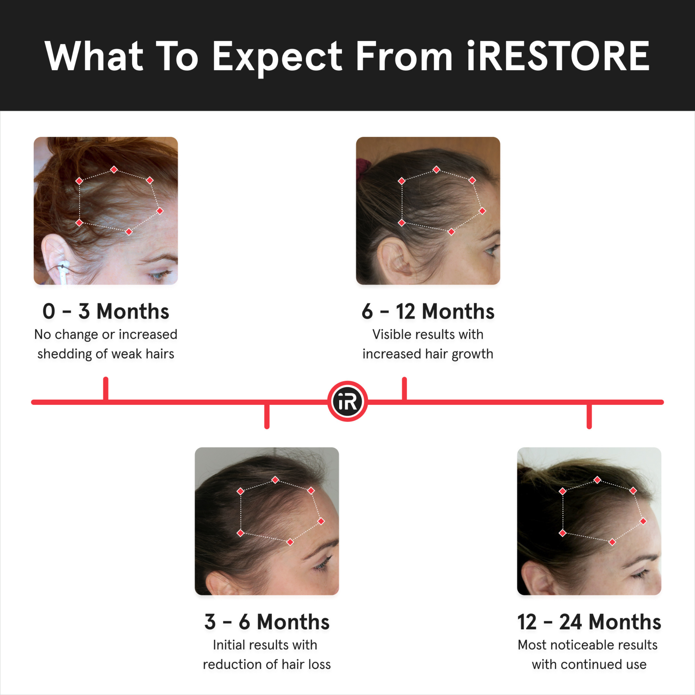 iRESTORE - Wholesale Scalp/Hair Treatment - iRESTORE PRO Laser Red Light Therapy Hair Growth5