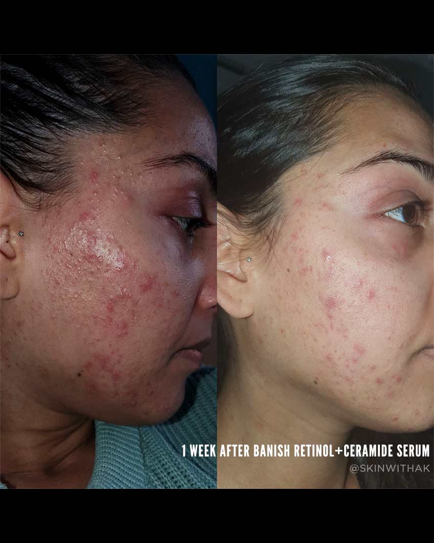 Banish - Wholesale Facial Serum/Concentrate - Retinol + Ceramide Serum2