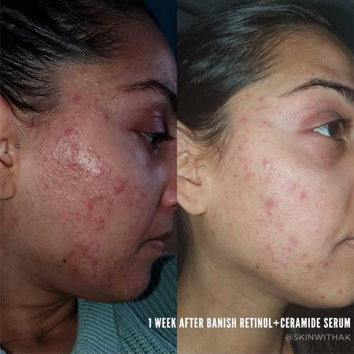 Banish - Wholesale Facial Serum/Concentrate - Retinol + Ceramide Serum2