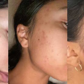 Douvall's - Vente Concentré/sérum pour le visage - Sérum de réadaptation contre l'acné 30 ml4