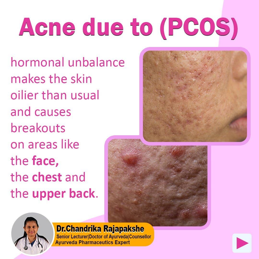 Secrets Of Tea - Wholesale Health/Detox Tea - Secrets Of Tea PCOS & PMS Be Gone Tea Support for Women - Symptom Relief, Mood, Acne, Skin darkens, and Menstrual Pain.2