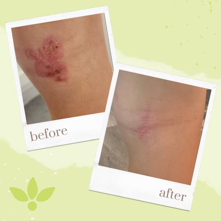 Honeoye Remedies - Wholesale Healing Salve/Balm/Cream - SAVE (MGO 550+) - Skin Balm, 8-pack with PDQ Display (30mL)4