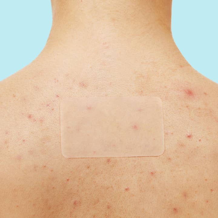 Rael - Wholesale Acne/Hydrocolloid Patch - Rael Miracle Patch XL Spot Control Cover - Pimple, Acne