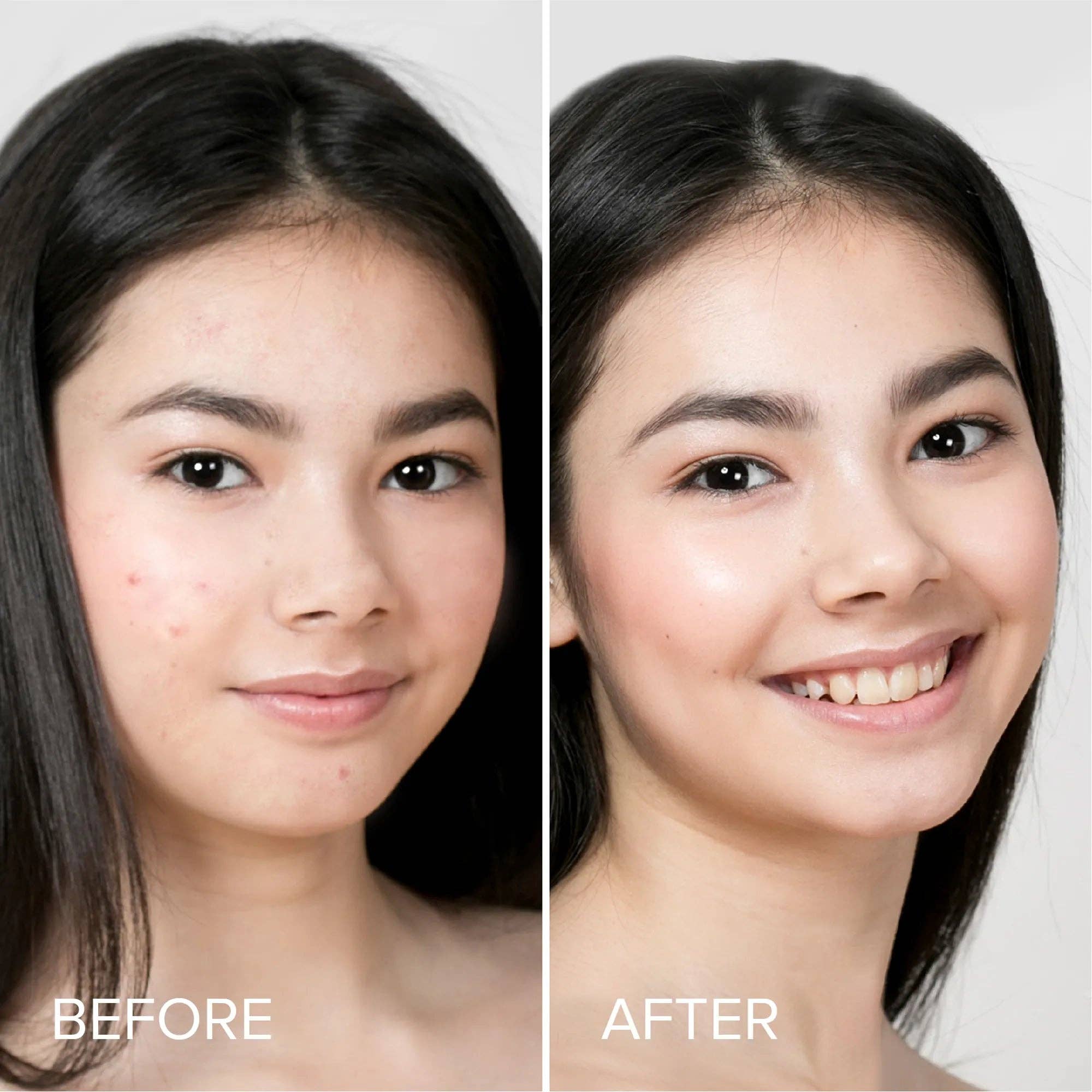 VIAI Beauty - Vente Patch contre l'acné/hydrocolloïde - Patchs pour boutons et acné2