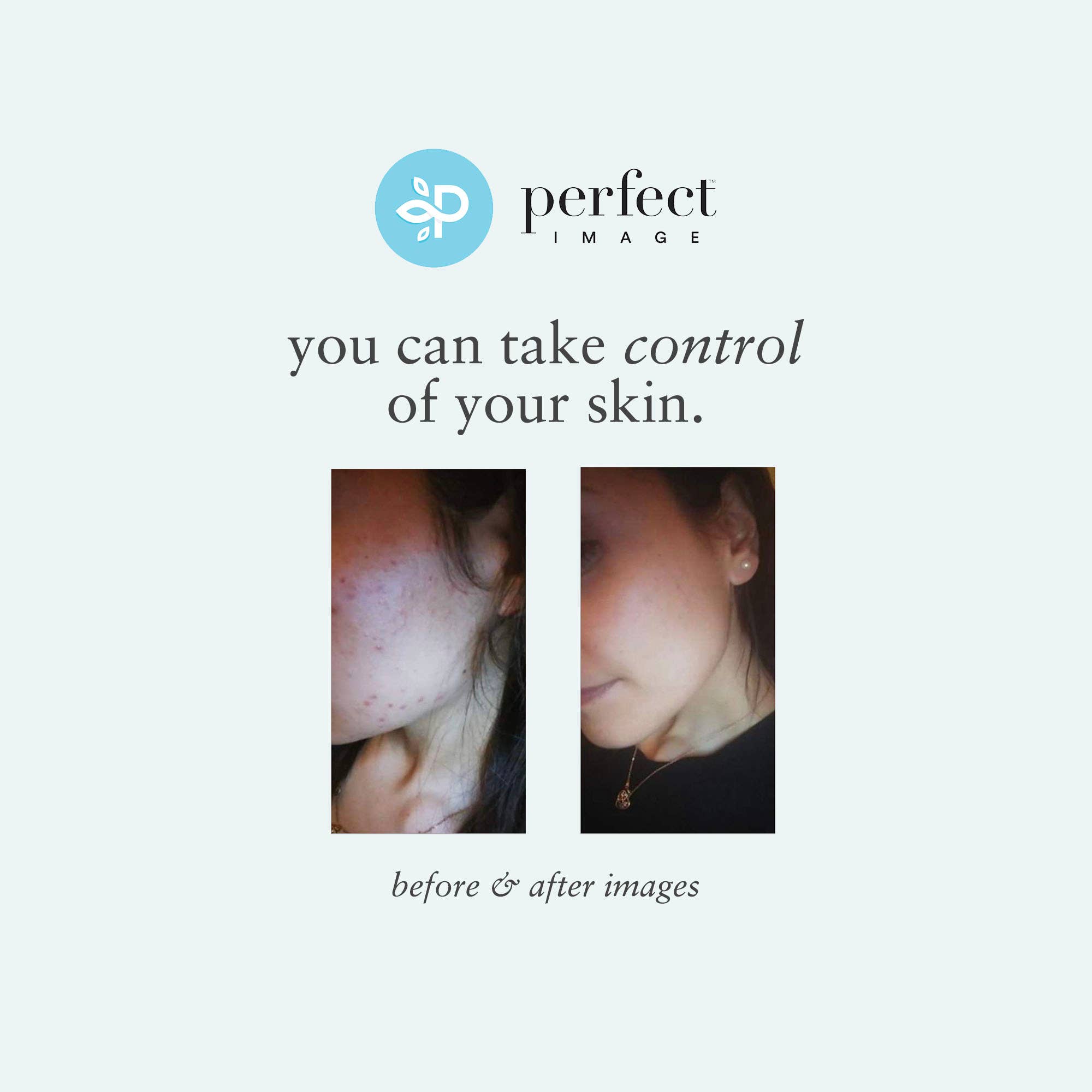 Perfect Image - Wholesale Facial Peel - Salicylic 20% Gel Peel - Level 29