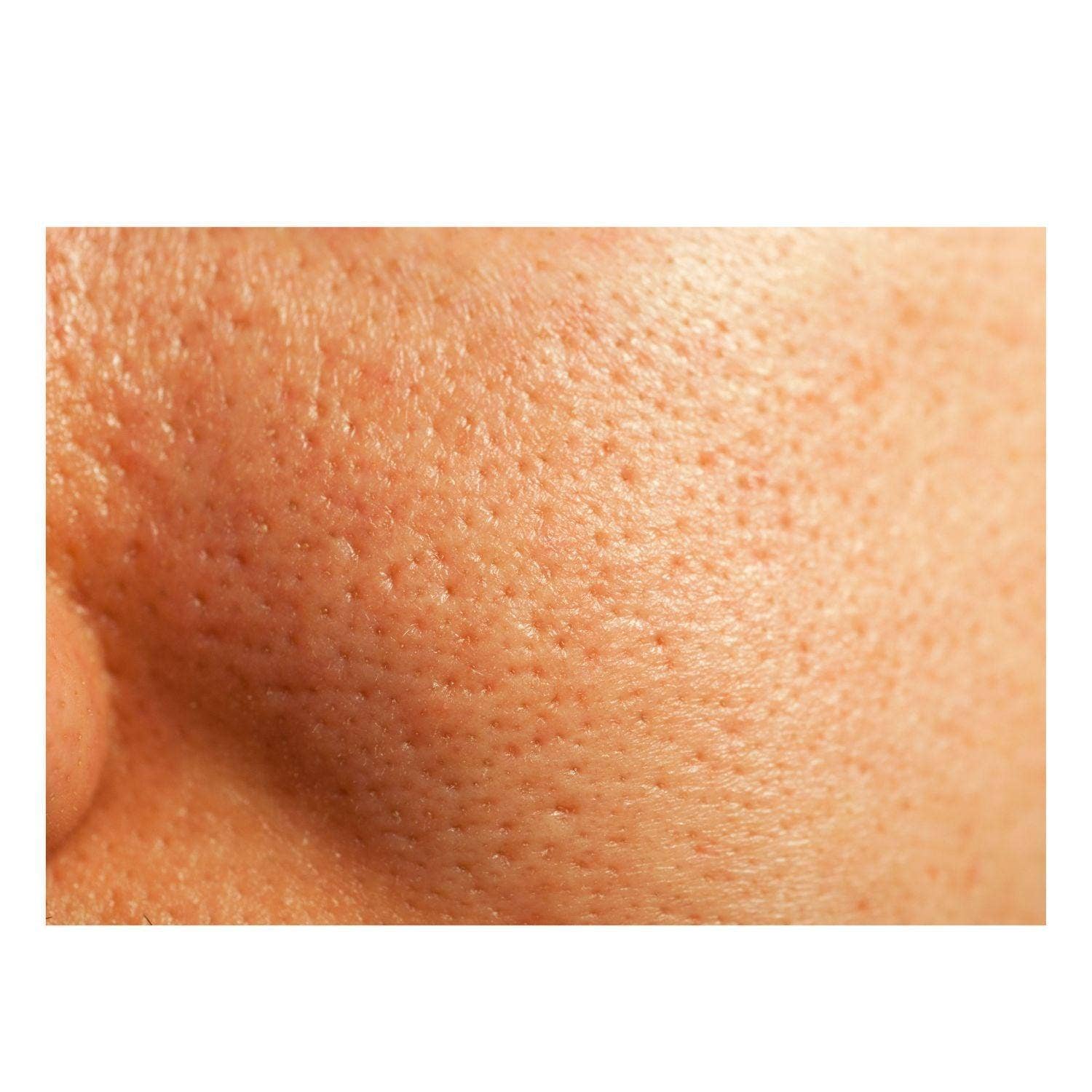 Gymsegbe - Wholesale Facial Peel - Thick As Thieves Pure Glycolic Acid Lactic Acid Extreme Gel Peel - 30ml6