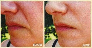 NATPURE Clinical Skin Care - Wholesale Face/Beauty Roller - CIT (Collagen Induction Therapy) Micro Needling Roller1