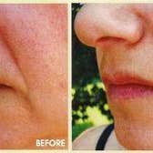 NATPURE Clinical Skin Care - Wholesale Face/Beauty Roller - CIT (Collagen Induction Therapy) Micro Needling Roller1