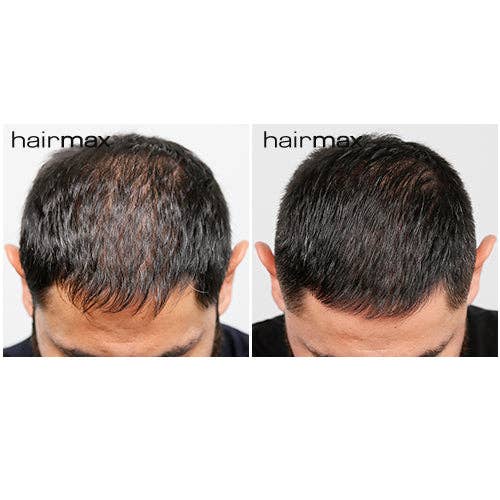 Hairmax - Wholesale Hair Thinning/Loss Treatment - LaserBand 82 Hair Growth Device for Hair loss