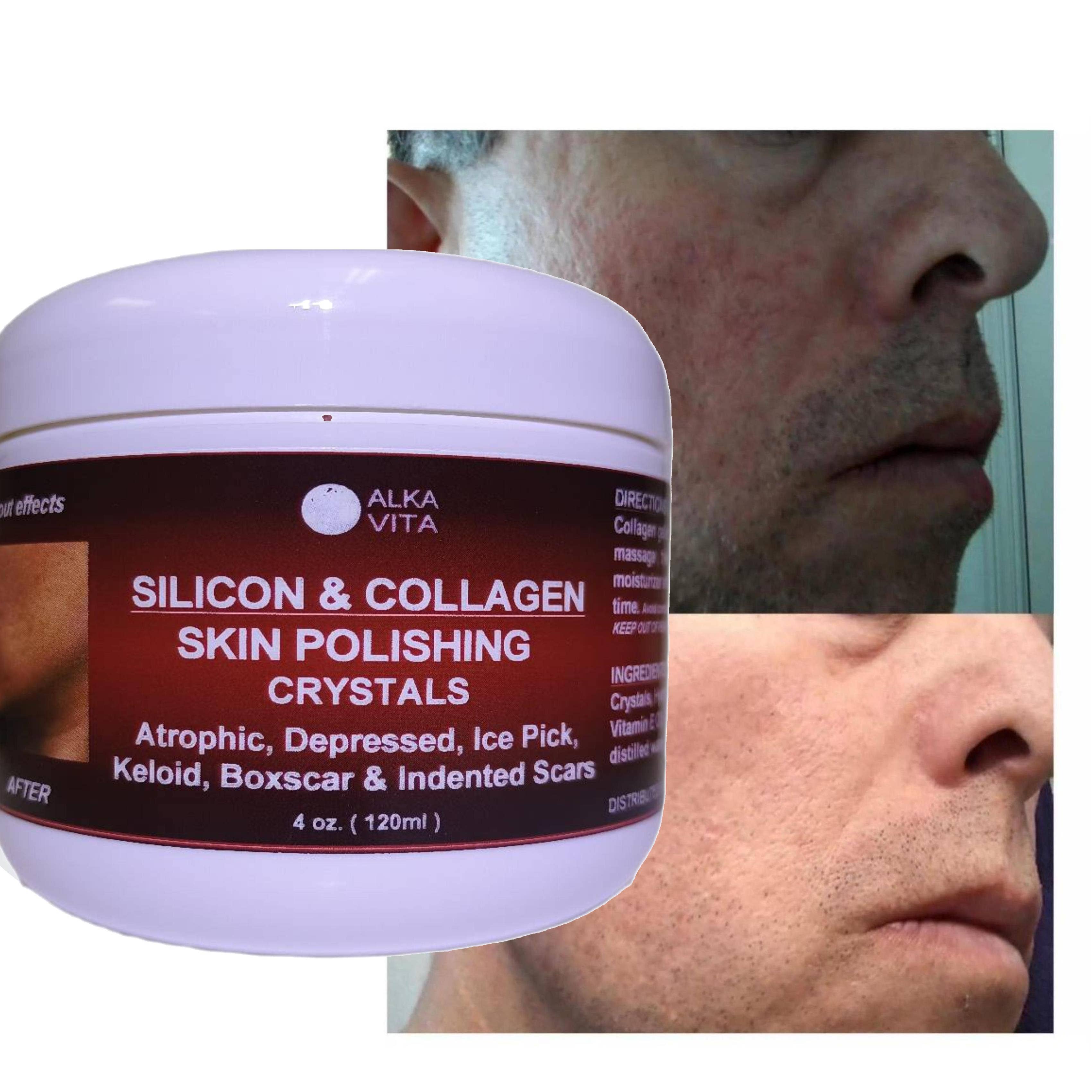 AlkaVita – Großhandel Akne-/Hydrokolloid-Pflaster – Silicon- und Kollagenpoliergel mit Kristallen gegen Aknenarben und Hautunebenheiten2