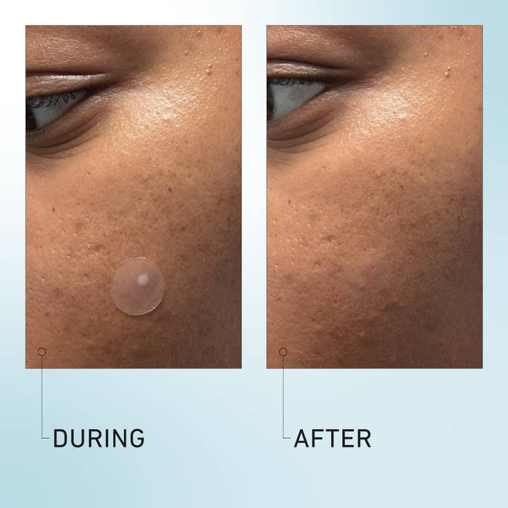 good light - Wholesale Acne/Hydrocolloid Patch - luna hydrocolloid acne pimple patch