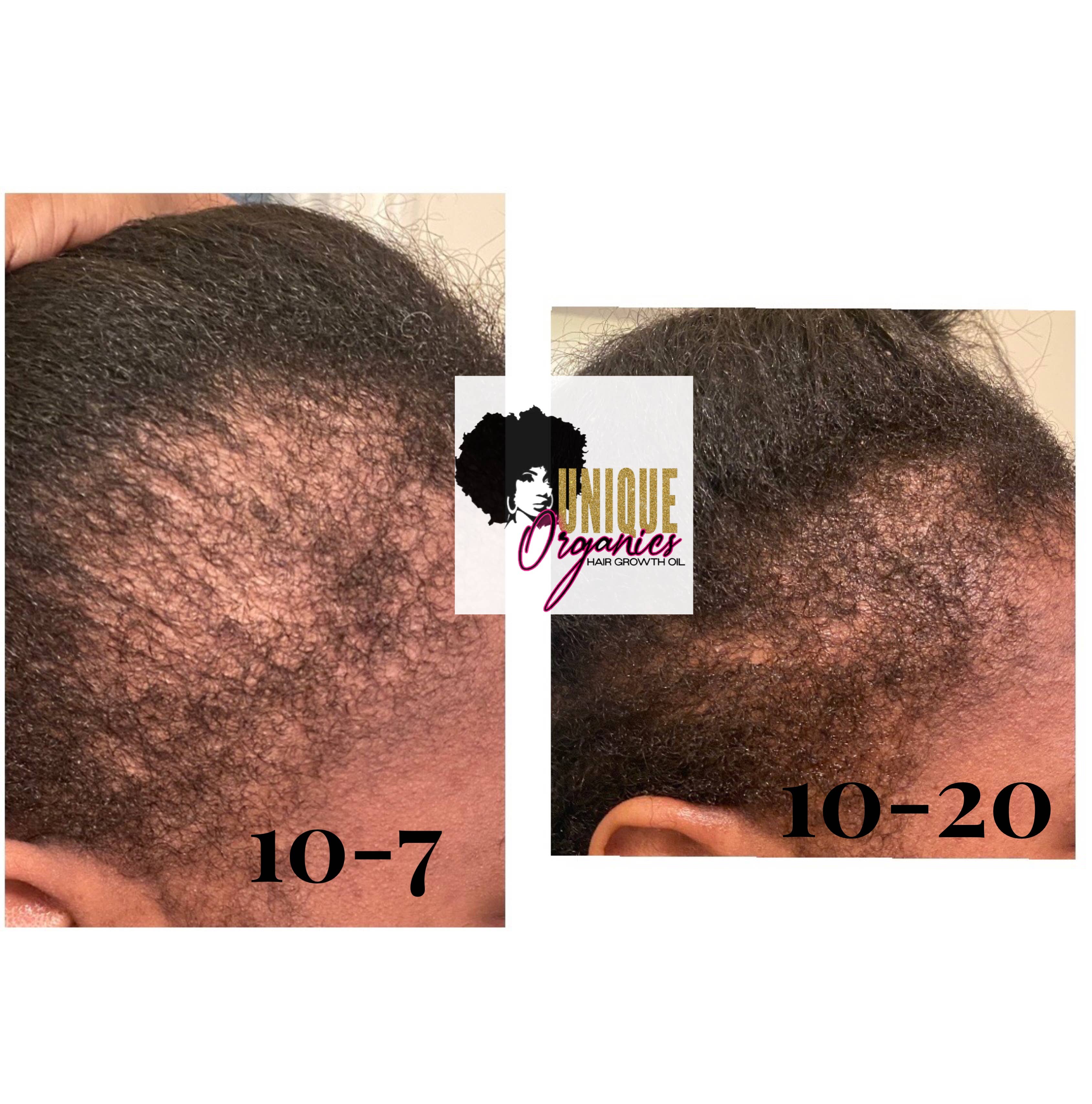 Unique Organics Haircare - Venta al por mayor Aceite capilar - Aceite para el cabello con 40 ingredientes contra la alopecia1